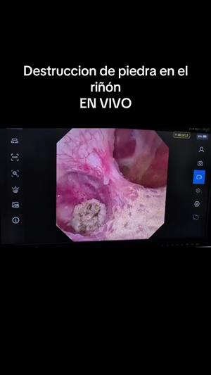 Destrucción de una piedra con láser, en vivo