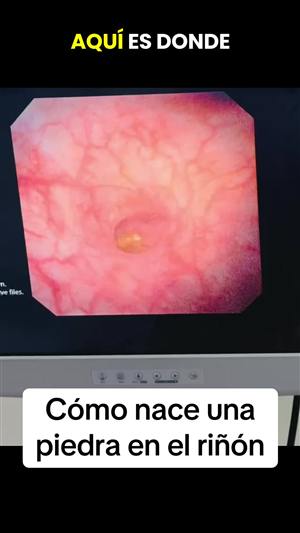 Cómo nace una piedra en el riñón