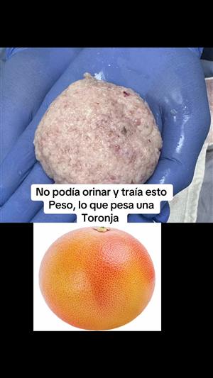 Una próstata del tamaño de una toronja